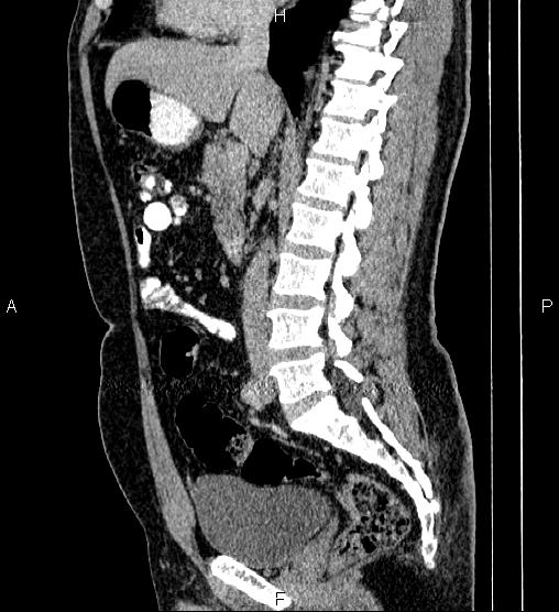 Acute appendicitis (Radiopaedia 84780-100240 Sagittal C+ portal venous phase 49).jpg