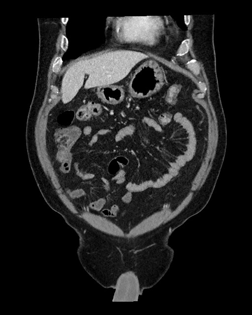Acute appendicitis - large appendicoliths (Radiopaedia 61805-69820 Coronal C+ portal venous phase 35).jpg