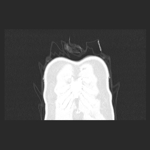 Acute appendicitis and COVID 19 pneumonia (Radiopaedia 76604-88380 G 5).jpg