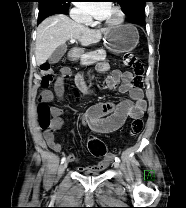 Acute arterial mesenteric ischemia (Radiopaedia 78238-90828 Coronal C+ portal venous phase 42).jpg