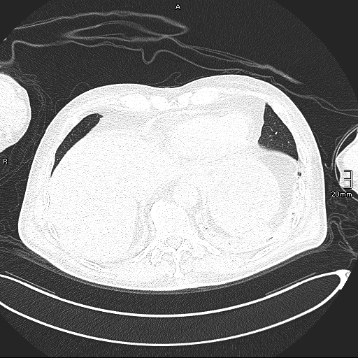 Acute aspiration pneumonitis (Radiopaedia 55642-62166 Axial lung window 129).jpg