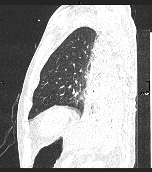 Acute aspiration pneumonitis (Radiopaedia 55642-62166 Sagittal lung window 31).jpg