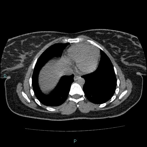 Acute bilateral pyelonephritis (Radiopaedia 37146-38881 Axial non-contrast 3).jpg