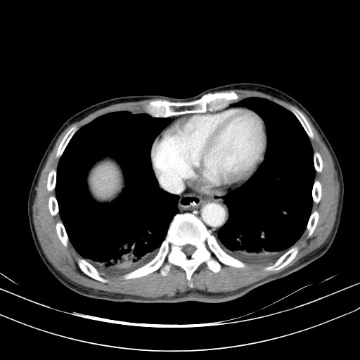 Acute bowel ischemia (Radiopaedia 87695-104114 Axial C+ portal venous phase 8).jpg