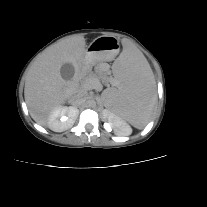 File:Acute calculous cholecystitis in patient with osteopetrosis (Radiopaedia 77871-90159 Axial C+ delayed 10).jpg