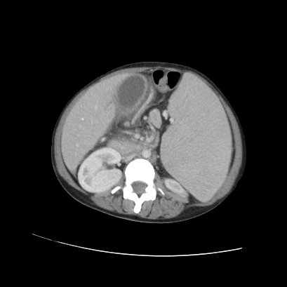 Acute calculous cholecystitis in patient with osteopetrosis (Radiopaedia 77871-90159 Axial C+ portal venous phase 43).jpg
