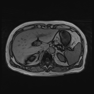 Acute cholecystitis (Radiopaedia 72392-82923 Axial T1 out-of-phase 42).jpg