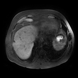 Acute cholecystitis complicated by pylephlebitis (Radiopaedia 65782-74915 Axial T1 fat sat 7).jpg