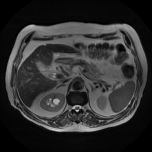 File:Acute cholecystitis complicated by pylephlebitis (Radiopaedia 65782-74915 Axial T2 17).jpg