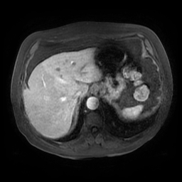 Acute cholecystitis complicated by pylephlebitis (Radiopaedia 65782-74915 Axial arterioportal phase T1 C+ fat sat 24).jpg