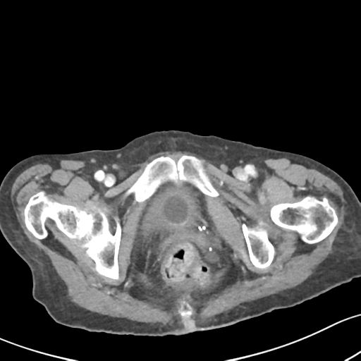 Acute cholecystitis with contained perforation (Radiopaedia 47328-51907 Axial C+ portal venous phase 72).png