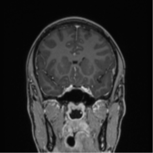 Acute disseminated encephalomyelitis (ADEM) (Radiopaedia 65319-74349 Coronal T1 C+ 37).png