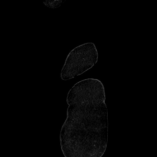 Acute diverticulitis - transverse colon (Radiopaedia 87063-103327 Sagittal C+ portal venous phase 16).jpg