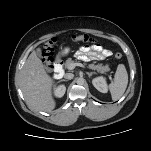 Acute diverticulitis with localized perforation (Radiopaedia 41296-44113 Axial C+ portal venous phase 29).jpg