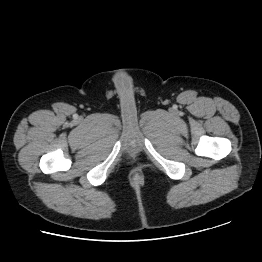 Acute diverticulitis with localized perforation (Radiopaedia 41296-44113 Axial C+ portal venous phase 99).jpg