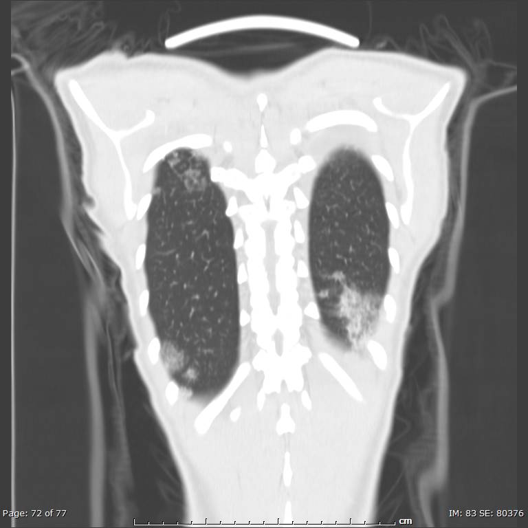 Acute eosinophilic pneumonia (Radiopaedia 48211-53073 Coronal lung window 49).jpg