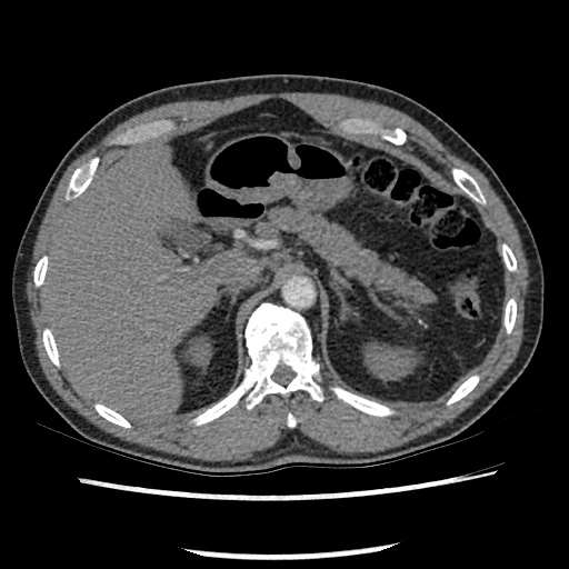 Acute epicardial fat necrosis (Radiopaedia 42327-45440 Axial C+ CTPA 91).jpg