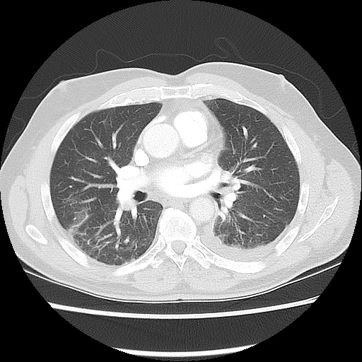 Acute epicardial fat necrosis (Radiopaedia 42327-45440 Axial lung window 31).jpg