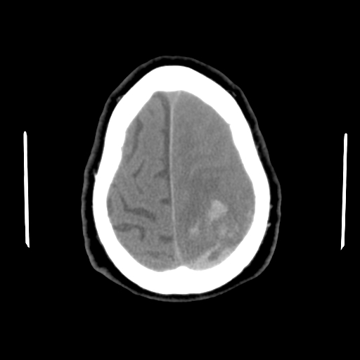 Acute hemorrhagic stroke (Radiopaedia 17507-17223 Axial non-contrast 44).jpg