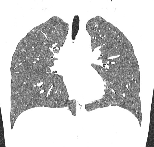 Acute hypersensitivity pneumonitis (Radiopaedia 85293-100870 Coronal lung window 63).jpg