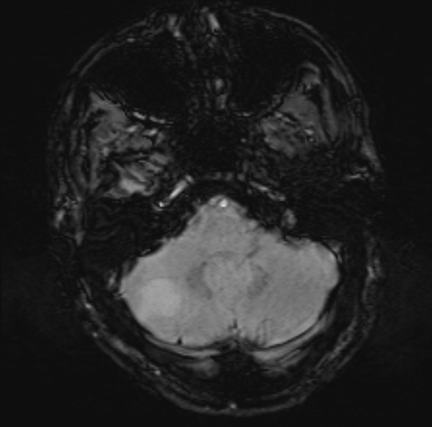Acute ischemic stroke - posterior circulation territory (Radiopaedia 77670-89880 Axial SWI 13).jpg