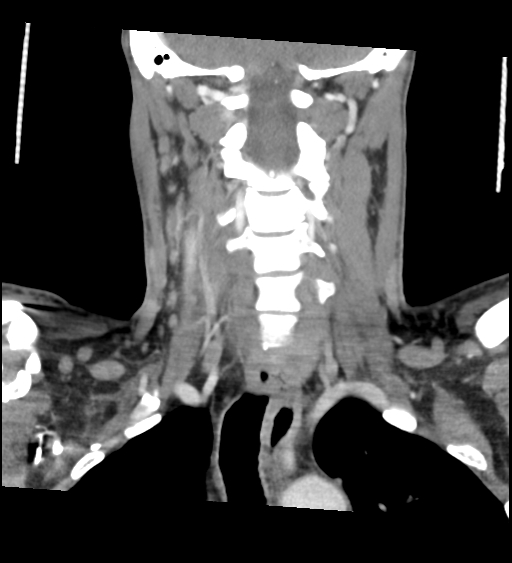Acute longus colli calcific tendinitis (Radiopaedia 72495-83036 Coronal C+ arterial phase 41).jpg