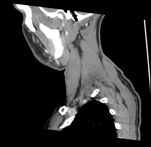 Acute longus colli calcific tendinitis (Radiopaedia 72495-83036 Sagittal C+ arterial phase 11).jpg