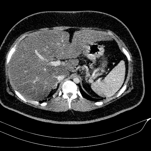 Acute on chronic pancreatitis (Radiopaedia 80902-94423 Axial C+ portal venous phase 40).jpg