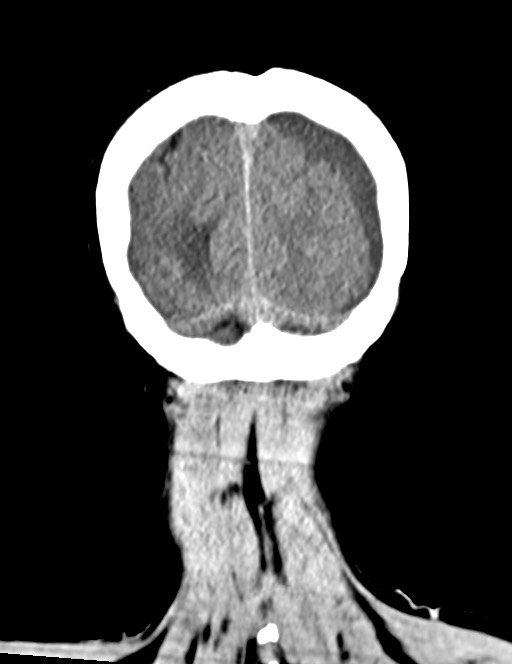Acute on chronic subdural hematoma (Radiopaedia 74814-85823 Coronal non-contrast 58).jpg