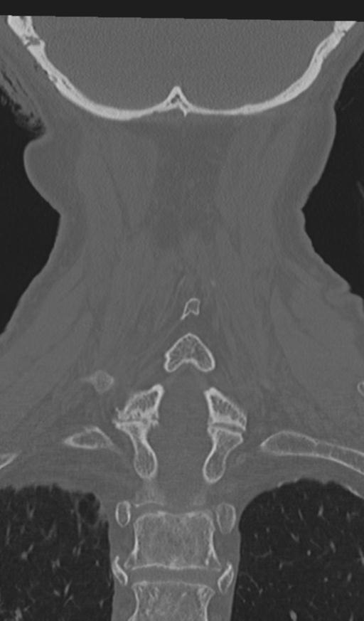 Acute on chronic subdural hematoma and thoracic vertebral injury in a multitrauma patient (Radiopaedia 31698-32619 Coronal bone window 51).jpg