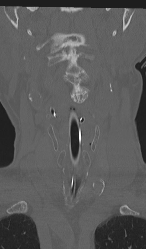 Acute on chronic subdural hematoma and thoracic vertebral injury in a multitrauma patient (Radiopaedia 31698-32619 Coronal bone window 9).jpg