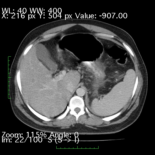 Acute pancreatitis (Radiopaedia 34043-35276 Axial C+ portal venous phase 22).jpg