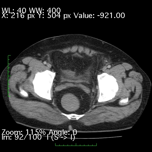 Acute pancreatitis (Radiopaedia 34043-35276 Axial C+ portal venous phase 92).jpg