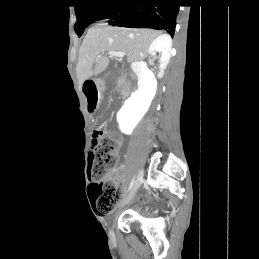File:Acute pancreatitis (Radiopaedia 50213-55558 Sagittal C+ portal venous phase 15).jpg