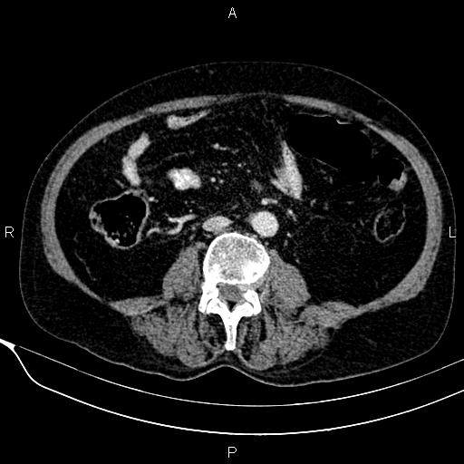 Acute pancreatitis (Radiopaedia 85146-100701 Axial C+ portal venous phase 39).jpg