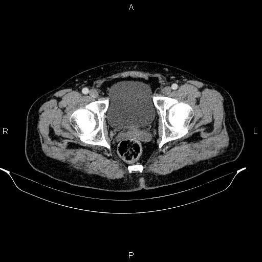 Acute pancreatitis (Radiopaedia 85390-101010 Axial C+ portal venous phase 104).jpg
