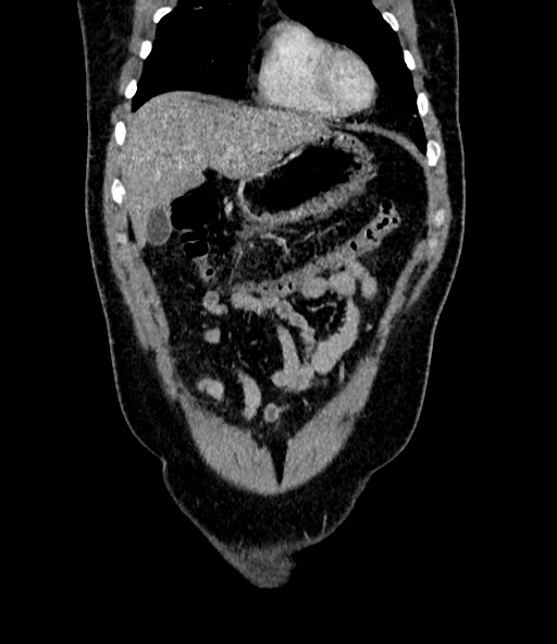 File:Acute pancreatitis (Radiopaedia 87428-103757 Coronal C+ portal venous phase 19).jpg