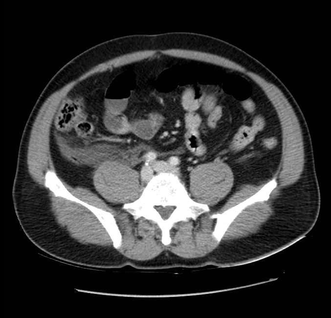 Acute pancreatitis - Balthazar E (Radiopaedia 23080-23110 Axial C+ portal venous phase 47).jpg