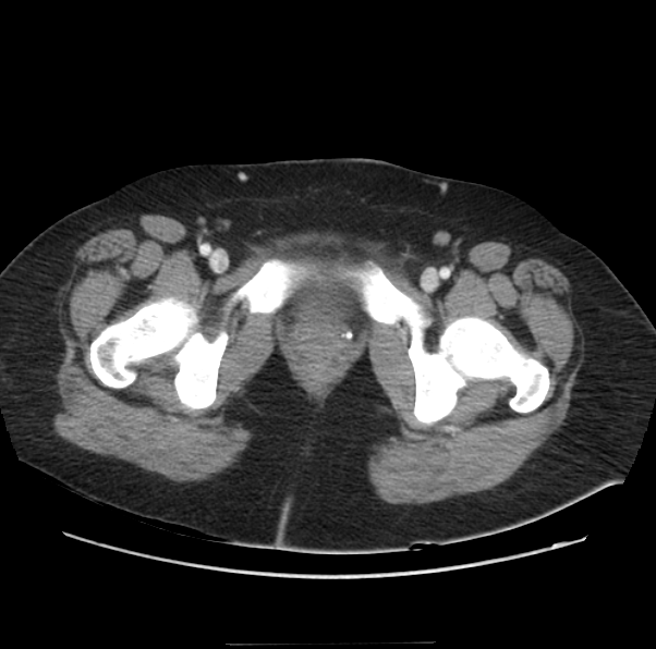 Acute pancreatitis - Balthazar E (Radiopaedia 29016-29377 Axial C+ portal venous phase 74).png