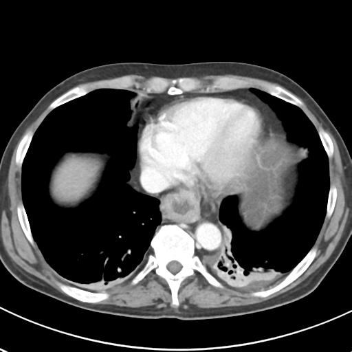 File:Acute pancreatitis and walled-off necrosis (Radiopaedia 29888-30404 Axial C+ portal venous phase 6).jpg