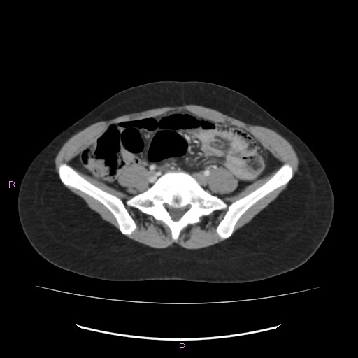 Acute pancreatitis secondary to stone at minor papilla and pancreatic divisum (Radiopaedia 76570-88333 Axial C+ portal venous phase 53).jpg