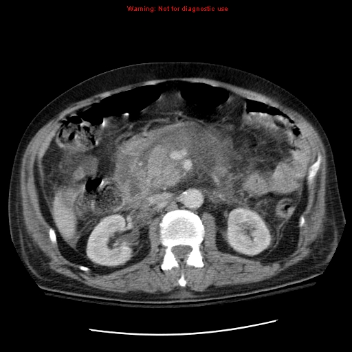 File:Acute pancreatitis with incidental pancreatic lipoma (Radiopaedia 10190-10730 Axial C+ portal venous phase 30).jpg