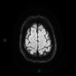 Acute posterior cerebral artery territory infarct (Radiopaedia 79329-92394 Axial DWI 25).jpg