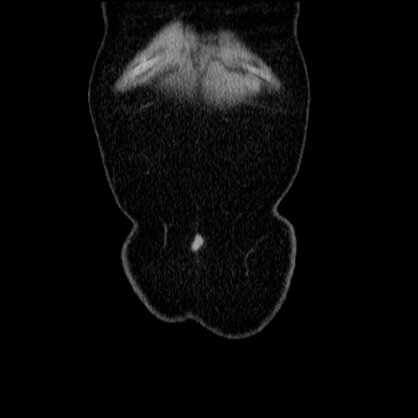 Acute pyelonephritis (Radiopaedia 33397-34434 Coronal renal parenchymal phase 11).jpg