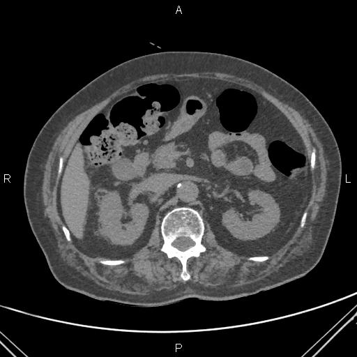 Acute renal artery occlusion (Radiopaedia 86586-102682 Axial non-contrast 27).jpg