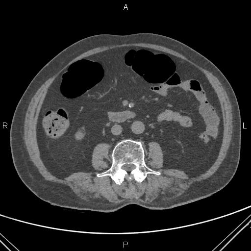 File:Acute renal artery occlusion (Radiopaedia 86586-102682 Axial non-contrast 42).jpg