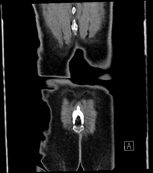 Acute renal infarction (Radiopaedia 59375-66736 Coronal C+ portal venous phase 61).jpg
