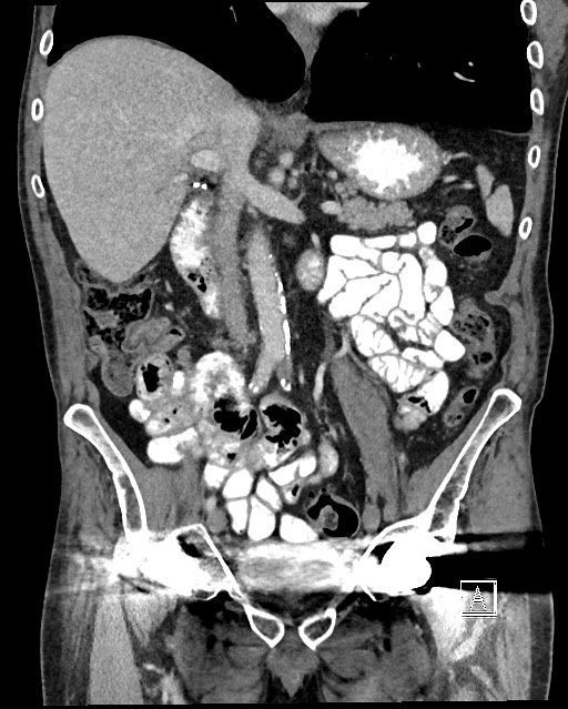 Acute renal infarction - rim capsular enhancement (Radiopaedia 59833-67270 Coronal C+ portal venous phase 24).jpg