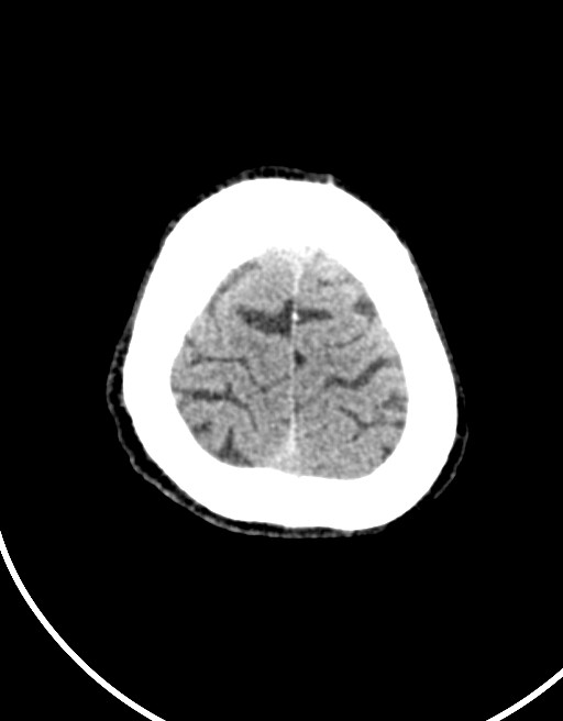 Acute superior cerebellar artery territory infarct (Radiopaedia 84104-99359 Axial non-contrast 13).jpg