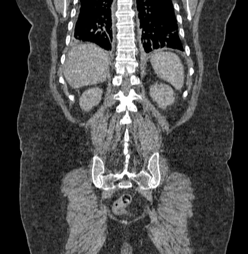 Acute superior mesenteric artery occlusion (Radiopaedia 51288-56960 Coronal C+ portal venous phase 61).jpg